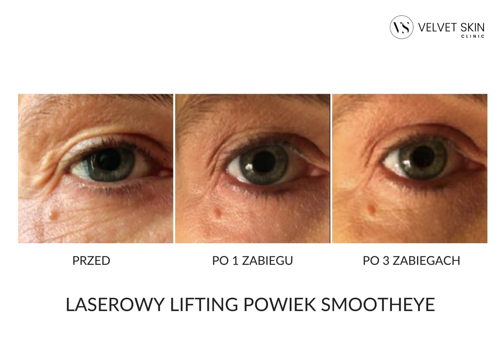 Laserowy lifting powiek SmoothEye — efekt przed i po serii zabiegów, worki pod oczami, Velvet Skin Clinic Warszawa