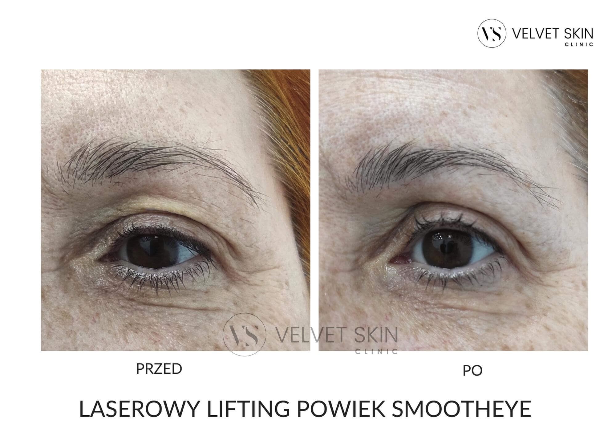 Laserowy lifting powiek SmoothEye — efekt przed i po serii zabiegów, Velvet Skin Clinic Warszawa