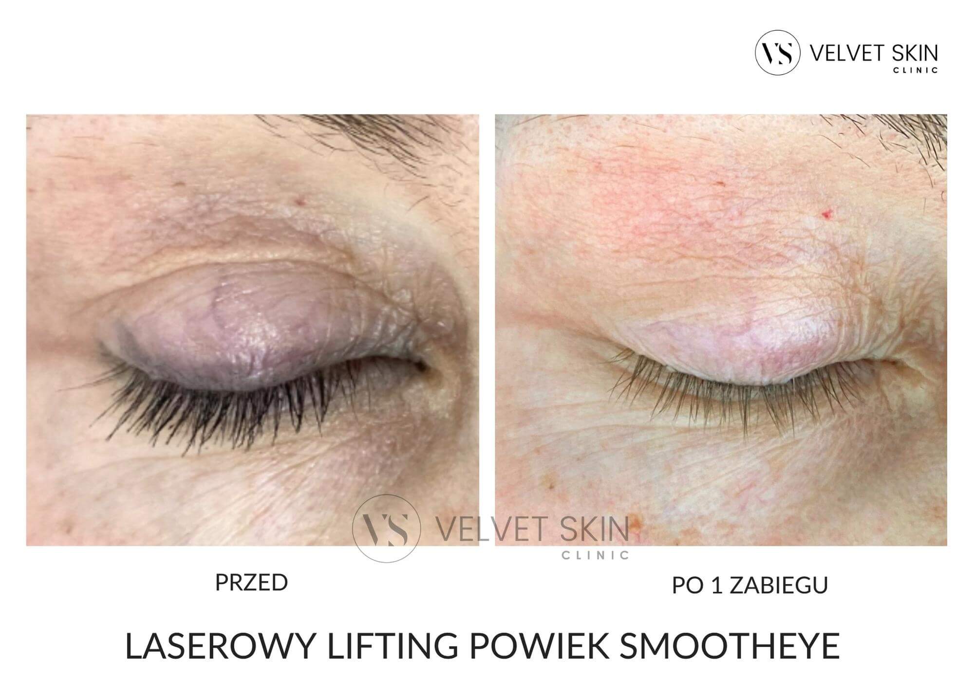 Laserowy lifting powiek SmoothEye — efekt przed i po zabiegu, kurze łapki, Velvet Skin Clinic Warszawa