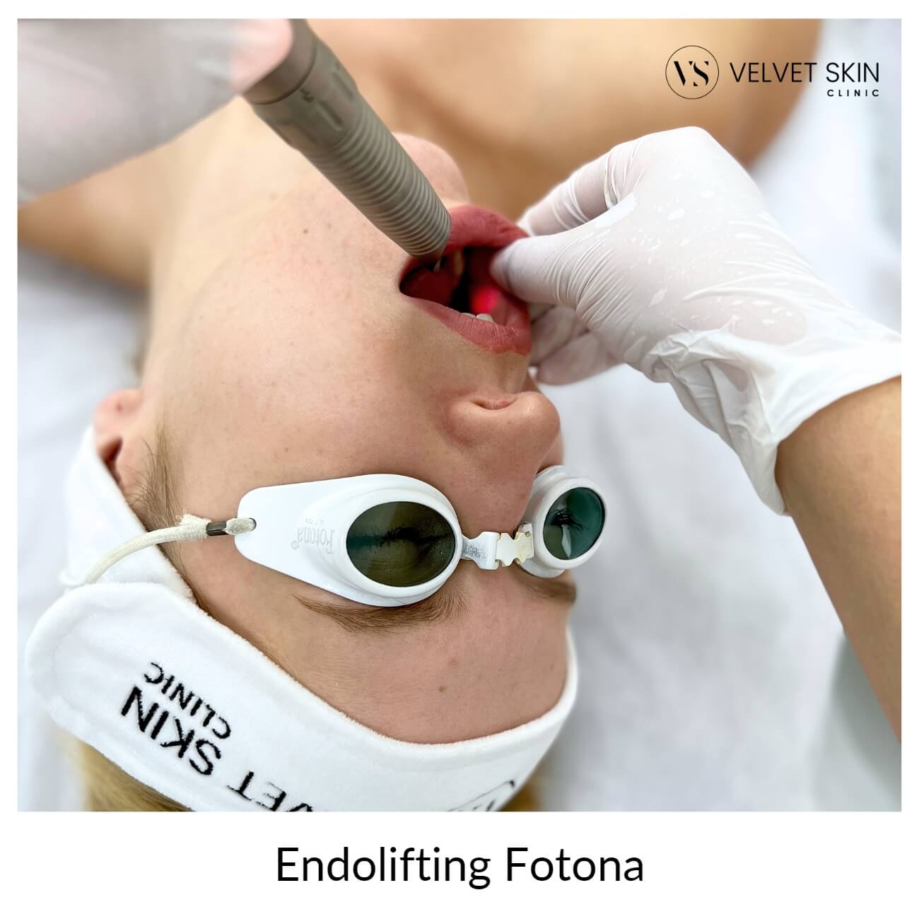 Lifting laserowy Fotona 4D — Velvet Skin Clinic
