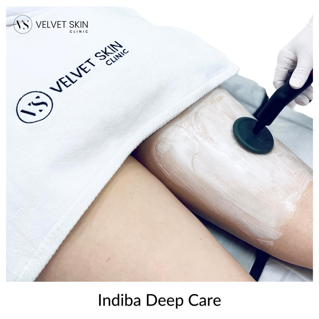 Indiba Deep Care — 448 kHz deep radiofrequency body treatment at Velvet Skin Clinic