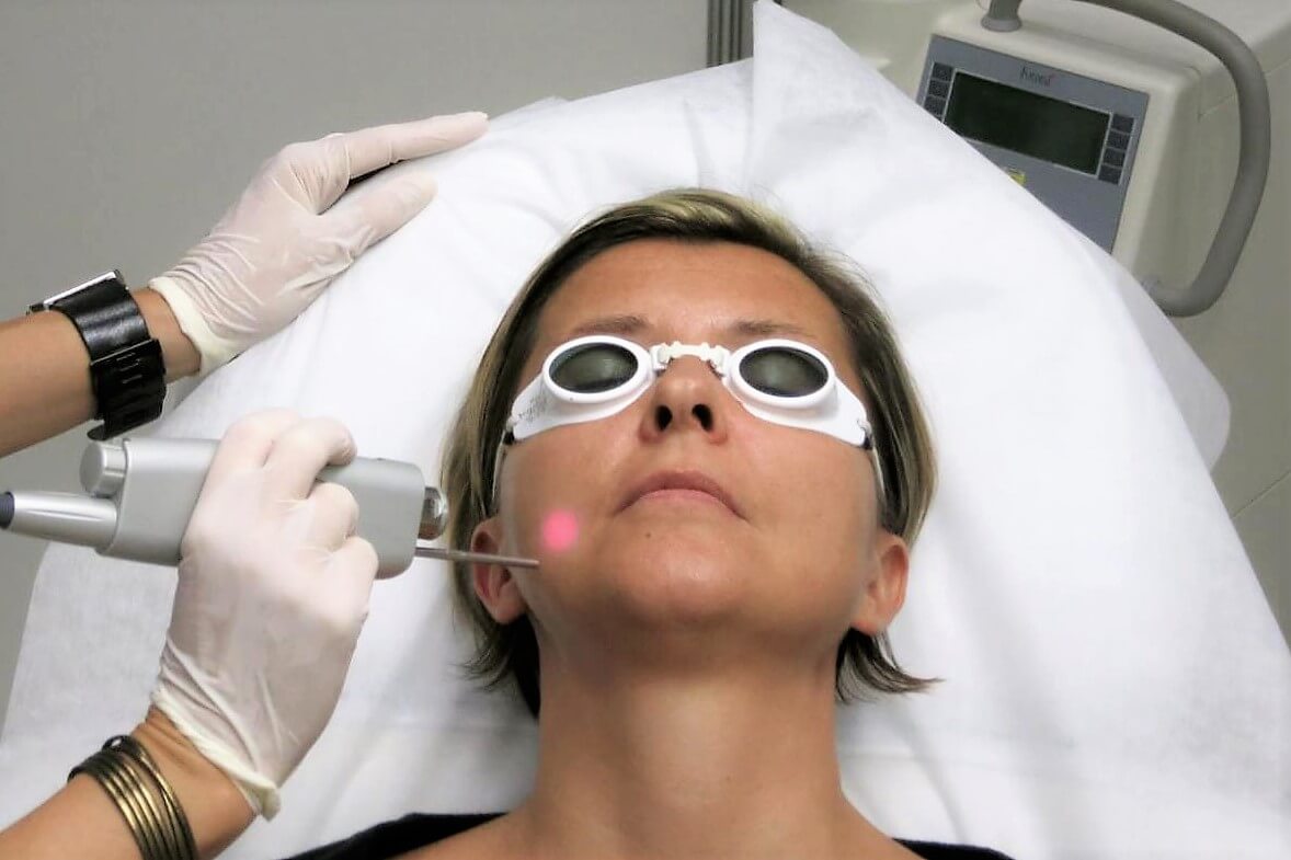 Fotona 4D etap PIANO — termolifting laserem Nd:YAG, Velvet Skin Clinic Warszawa