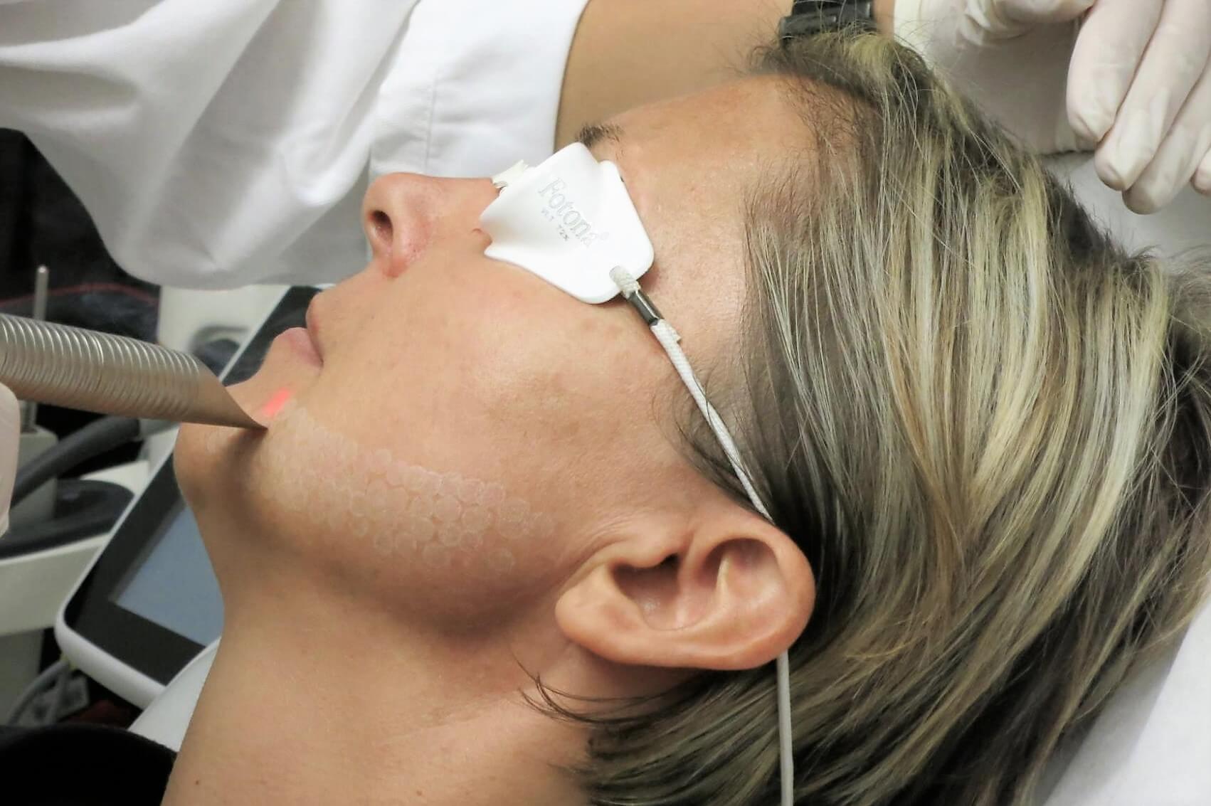 Fotona 4D etap SupErficial — peeling laserowy skóry twarzy, Velvet Skin Clinic Warszawa
