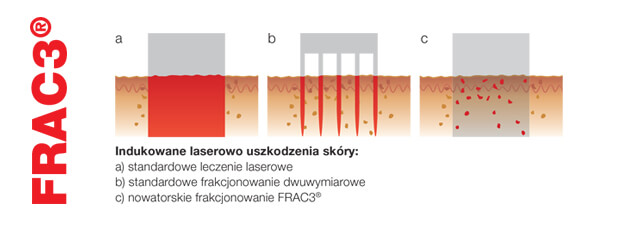 Fotoodmładzanie FRAC3™ — Frakcjonowanie FRAC3 Fotona a lasery frakcyjne CO2