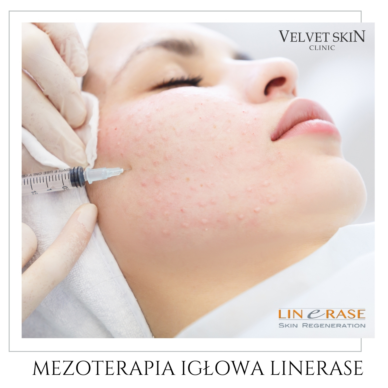 Linerase™ — Przebieg zabiegu Linerase