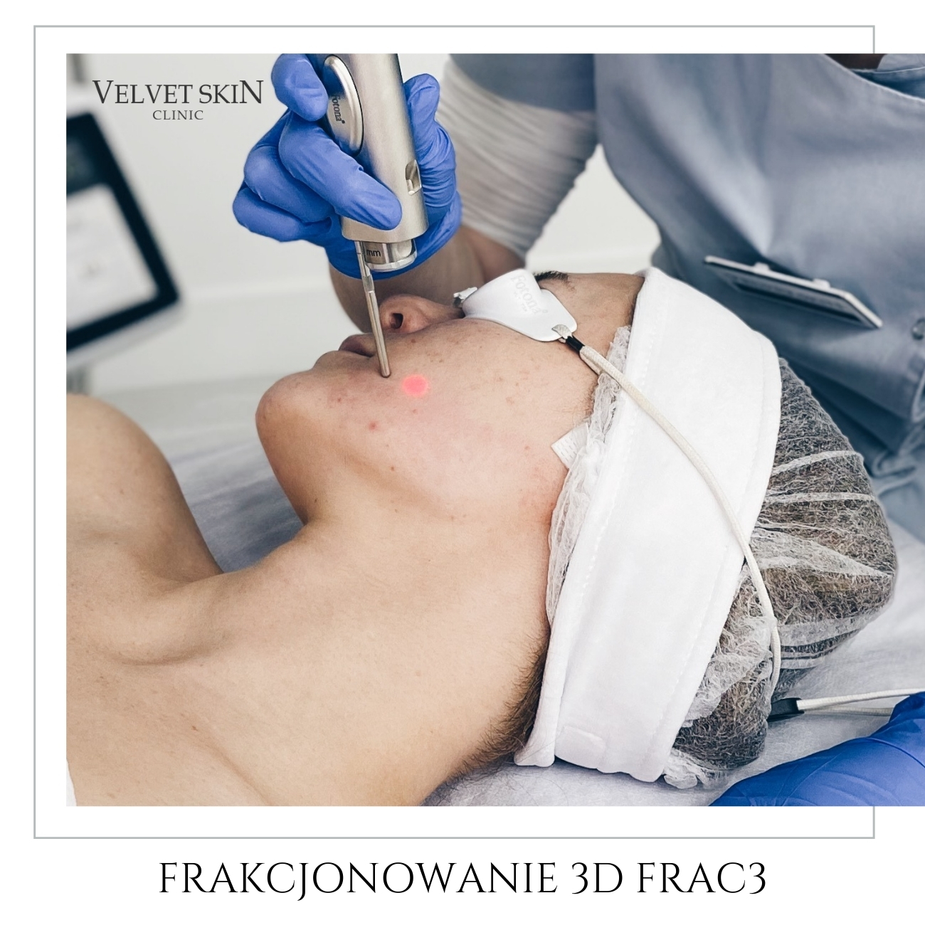 Fotoodmładzanie FRAC3™ — Frakcjonowanie 3D - fotoodmładzanie laserowe Frac3