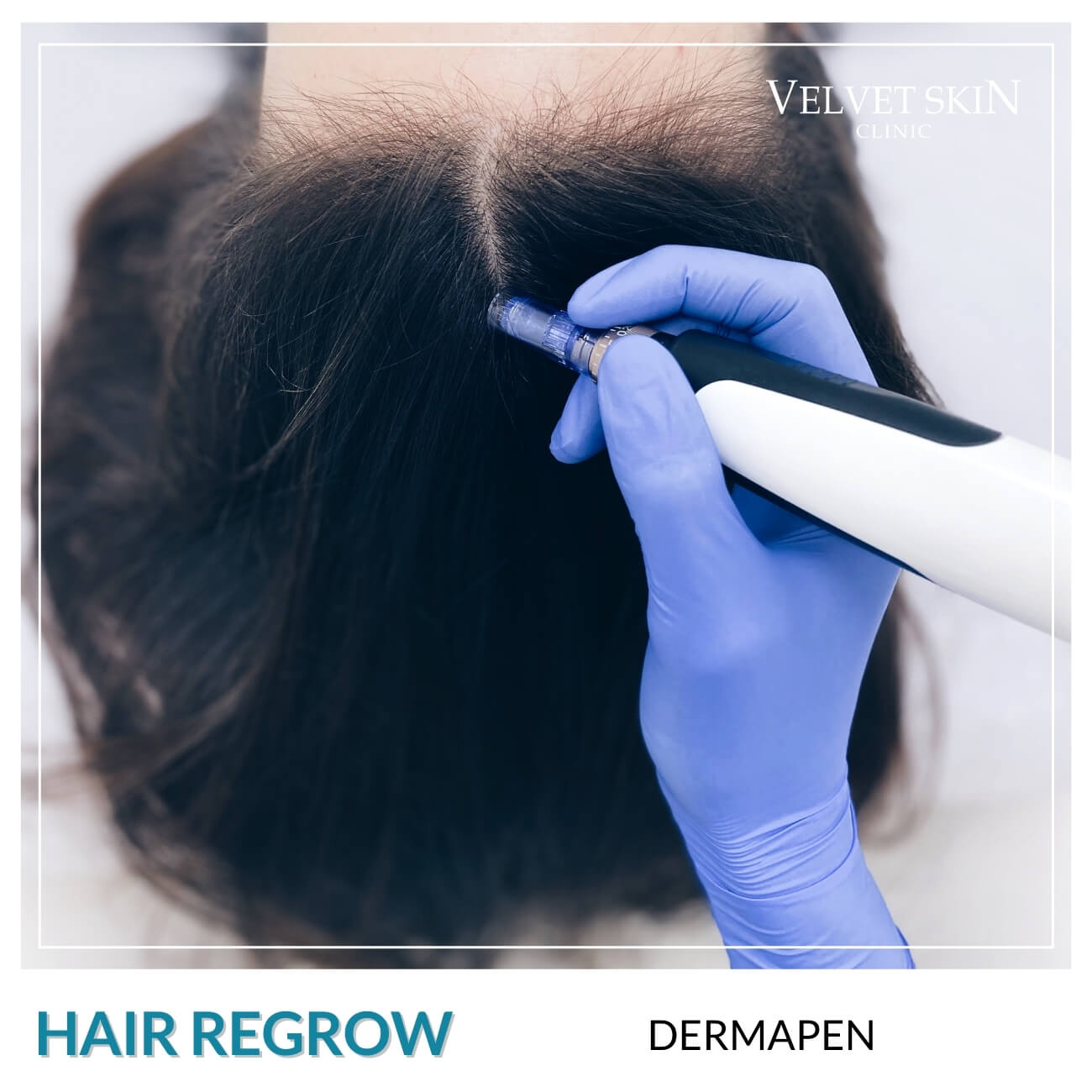 Program Hair Regrow — Zabiegi w składzie programu Hair Regrow