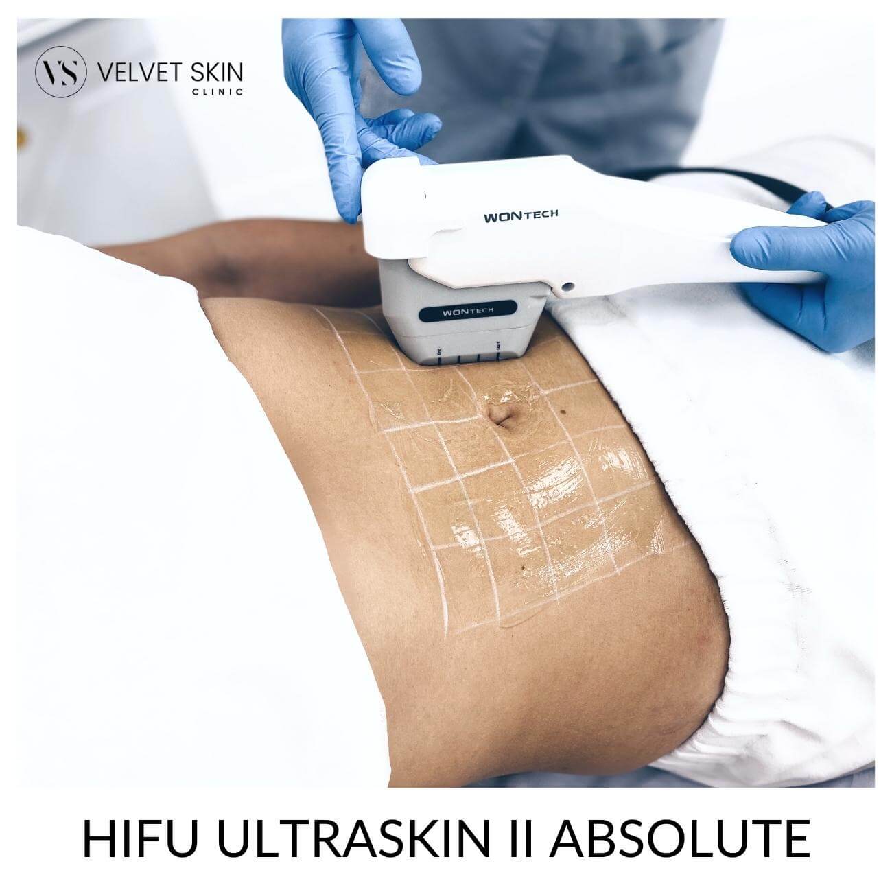 HIFU Ultraskin II Absolute - lifting SMAS — Velvet Skin Clinic