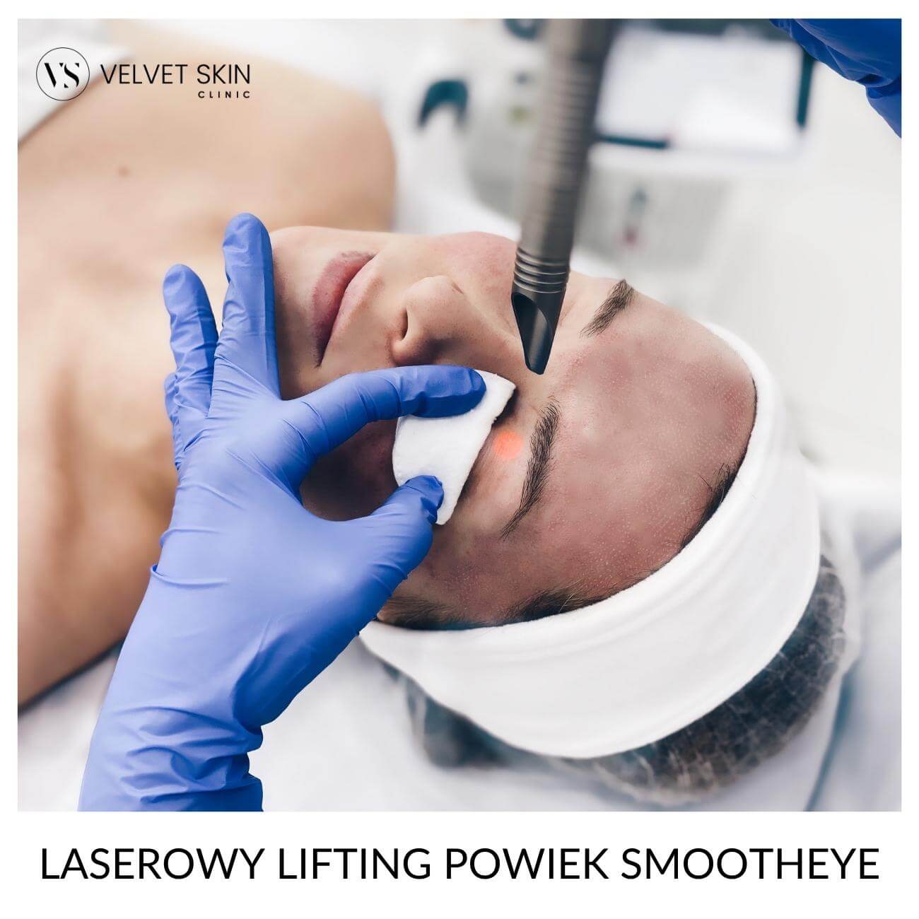 Laserowy lifting powiek SmoothEye — informacje o zabiegu, Velvet Skin Clinic