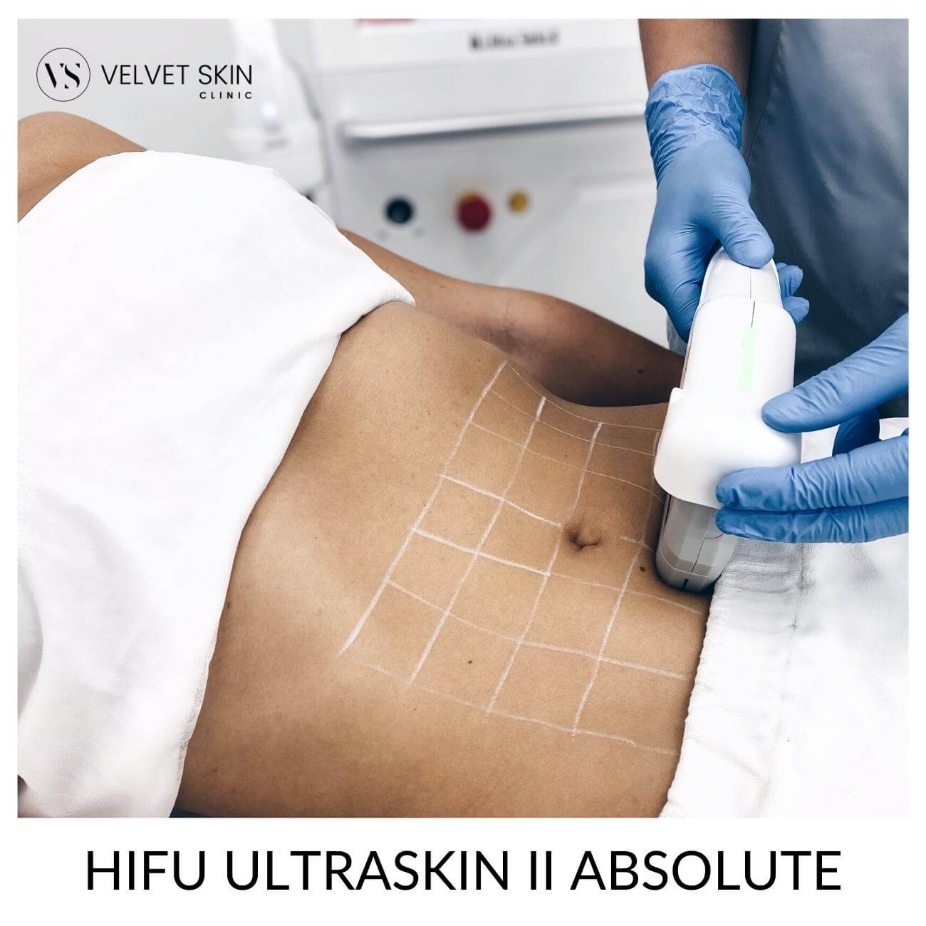 HIFU Ultraskin II Absolute - lifting SMAS — Velvet Skin Clinic