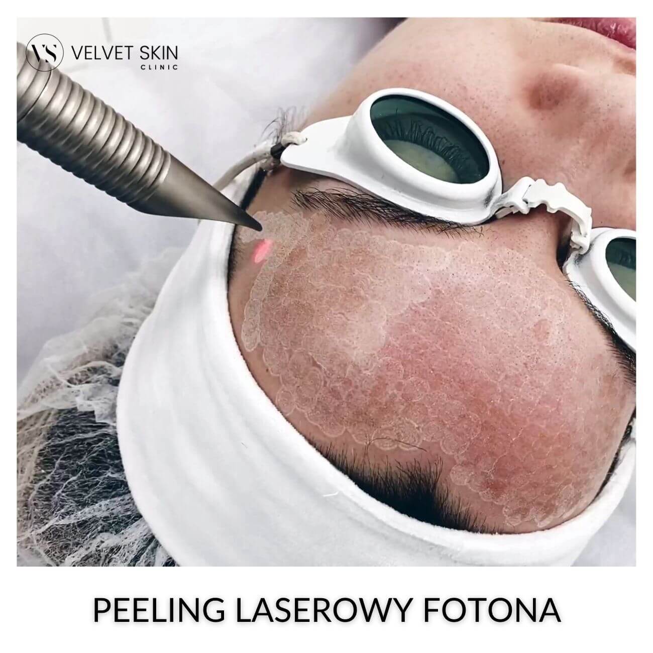 Peeling laserowy Fotona — etap 3 terapii Laser Skin Renewal
