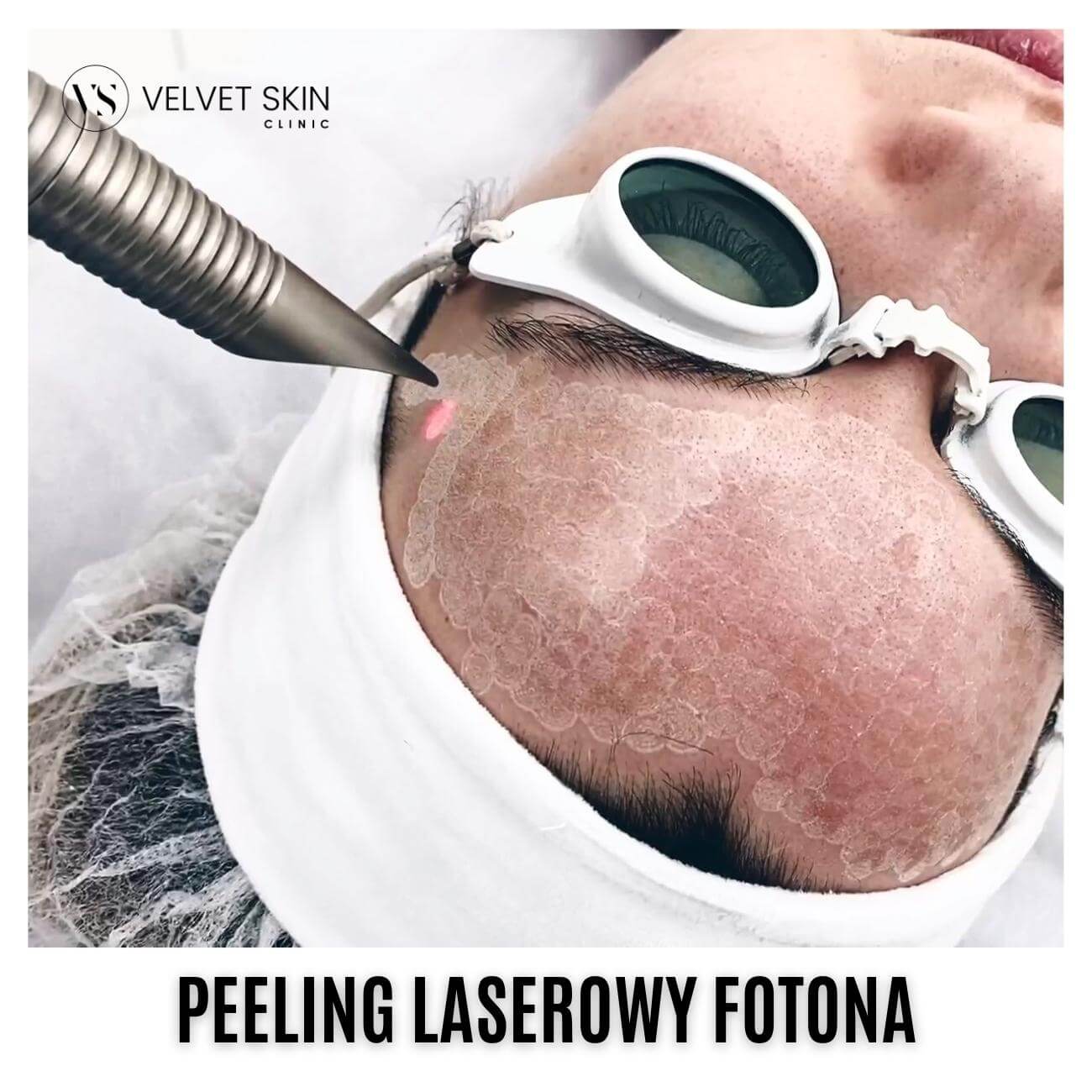 Peeling laserowy Fotona™ — Peeling laserowy Fotona™️