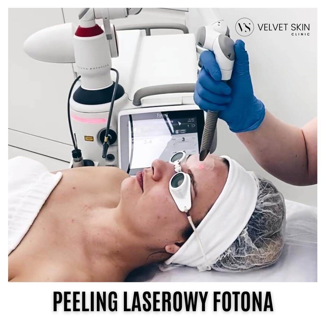 Peeling laserowy Fotona™ — Peeling laserowy Fotona