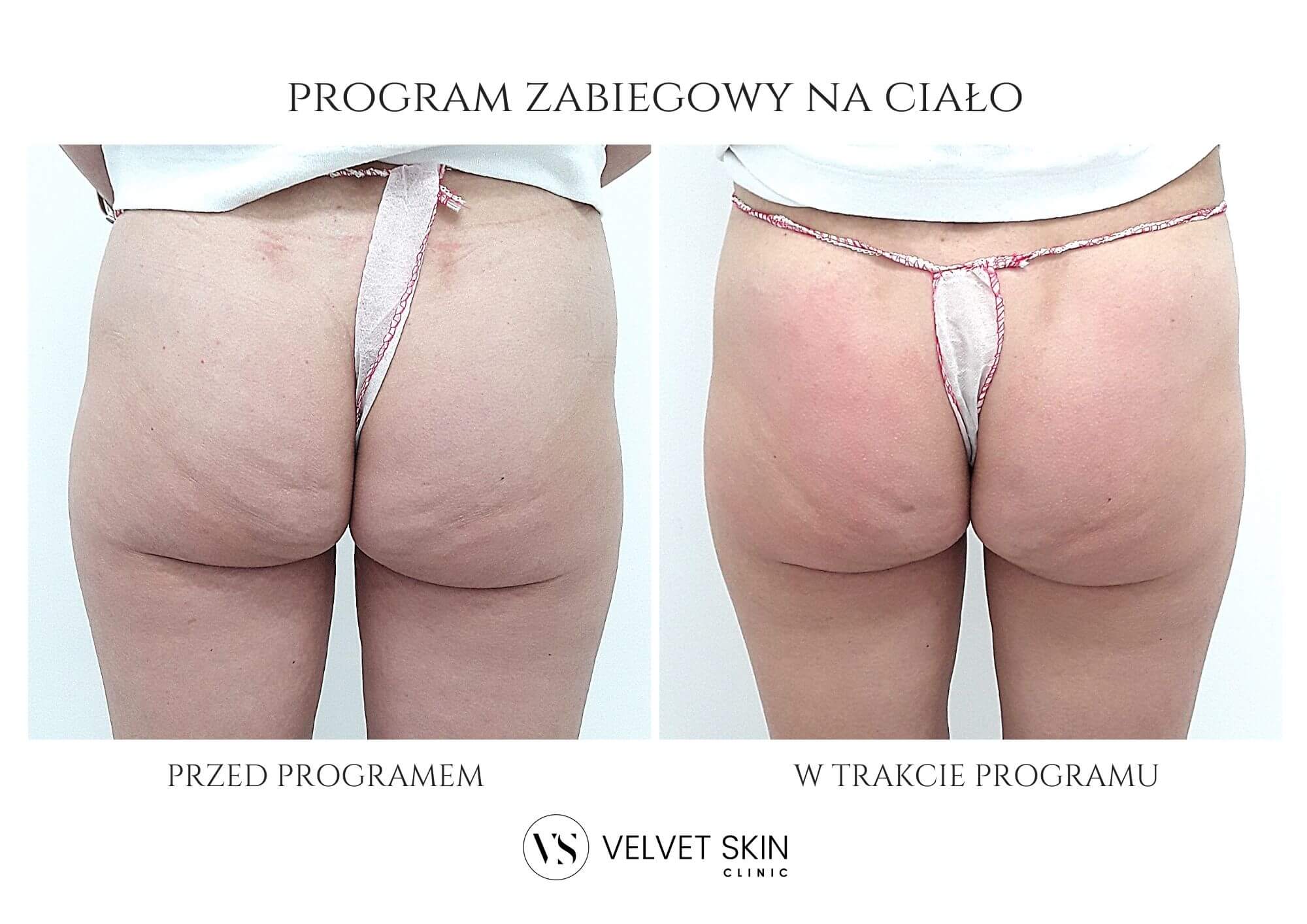 Program No Cellulite jędrna skóra bez cellulitu w 6 tygodni — efekt zabiegów w Velvet Skin Clinic