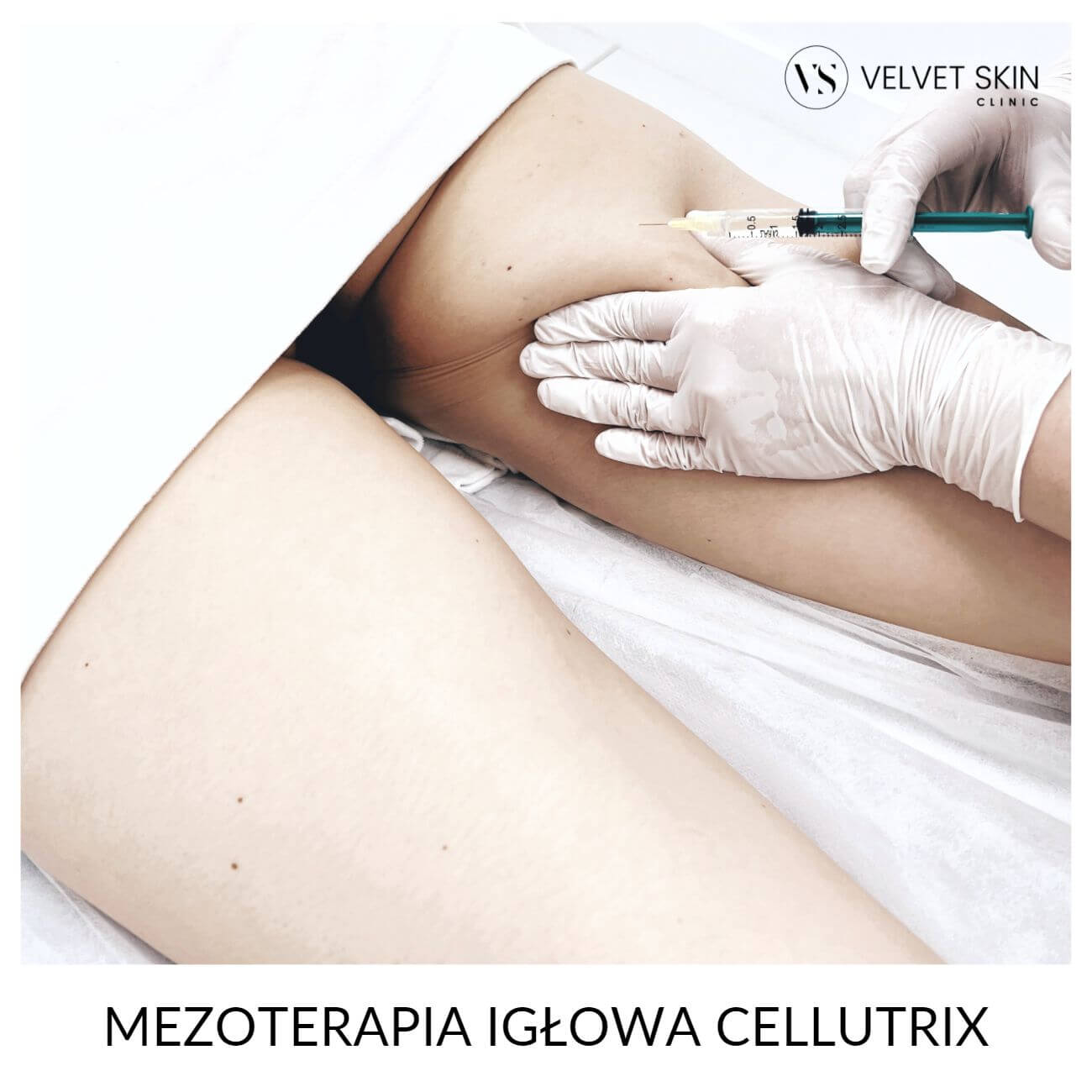 Program No Cellulite jędrna skóra bez cellulitu w 6 tygodni — Fala akustyczna Storz Medical