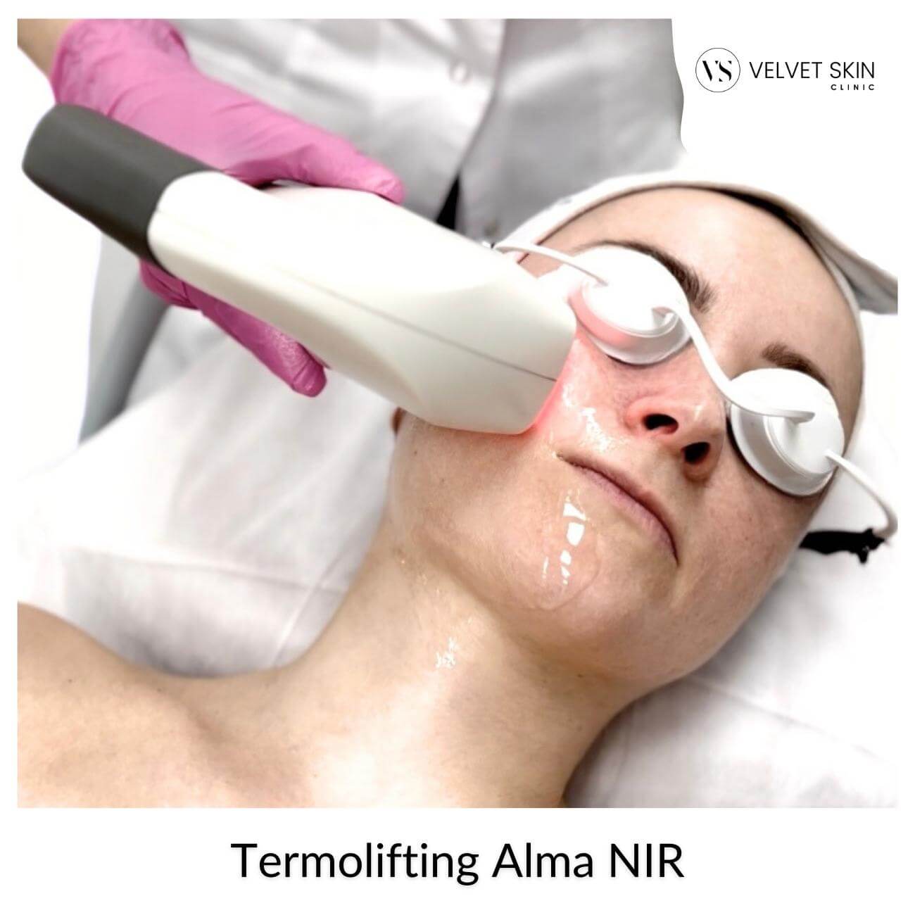 Termolifting Alma NIR™ — Termolifting Alma NIR- nieinwazyjny lifting twarzy i ujędrnianie skóry