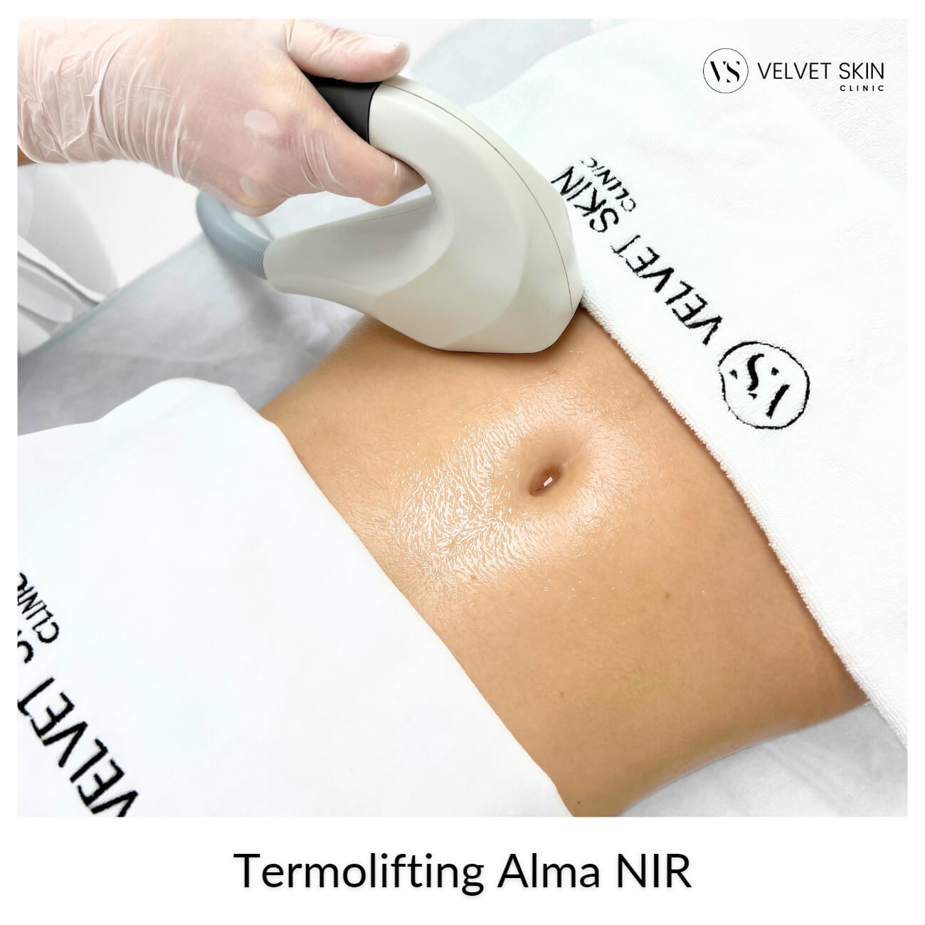 Termolifting Alma NIR™ — Przebieg termoliftingu Alma NIR
