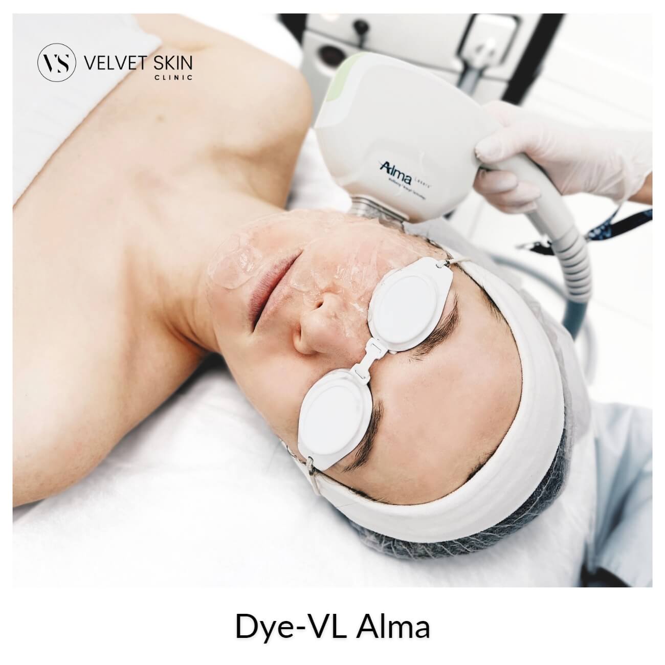 Dye-VL™ Alma — Zabieg Alma Dye-VL - laserowe likwidacja naczynek, rumienia i przebarwień