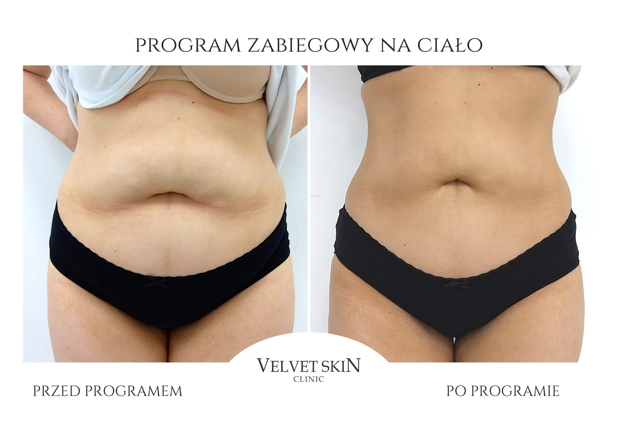 Slim Body Premium autorski program modelujący ciało — efekt zabiegów w Velvet Skin Clinic