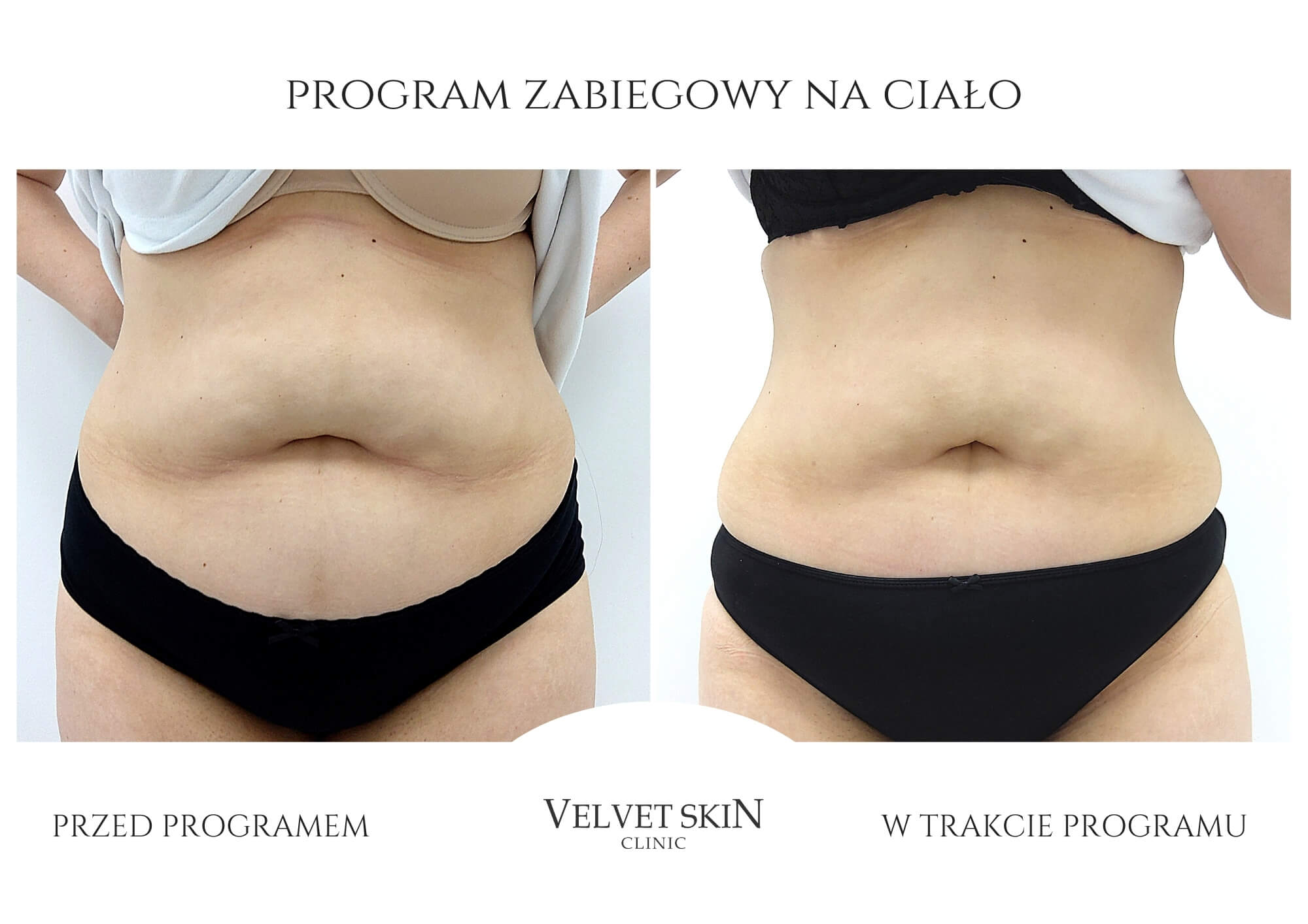 Slim Body Premium autorski program modelujący ciało — efekt zabiegów w Velvet Skin Clinic