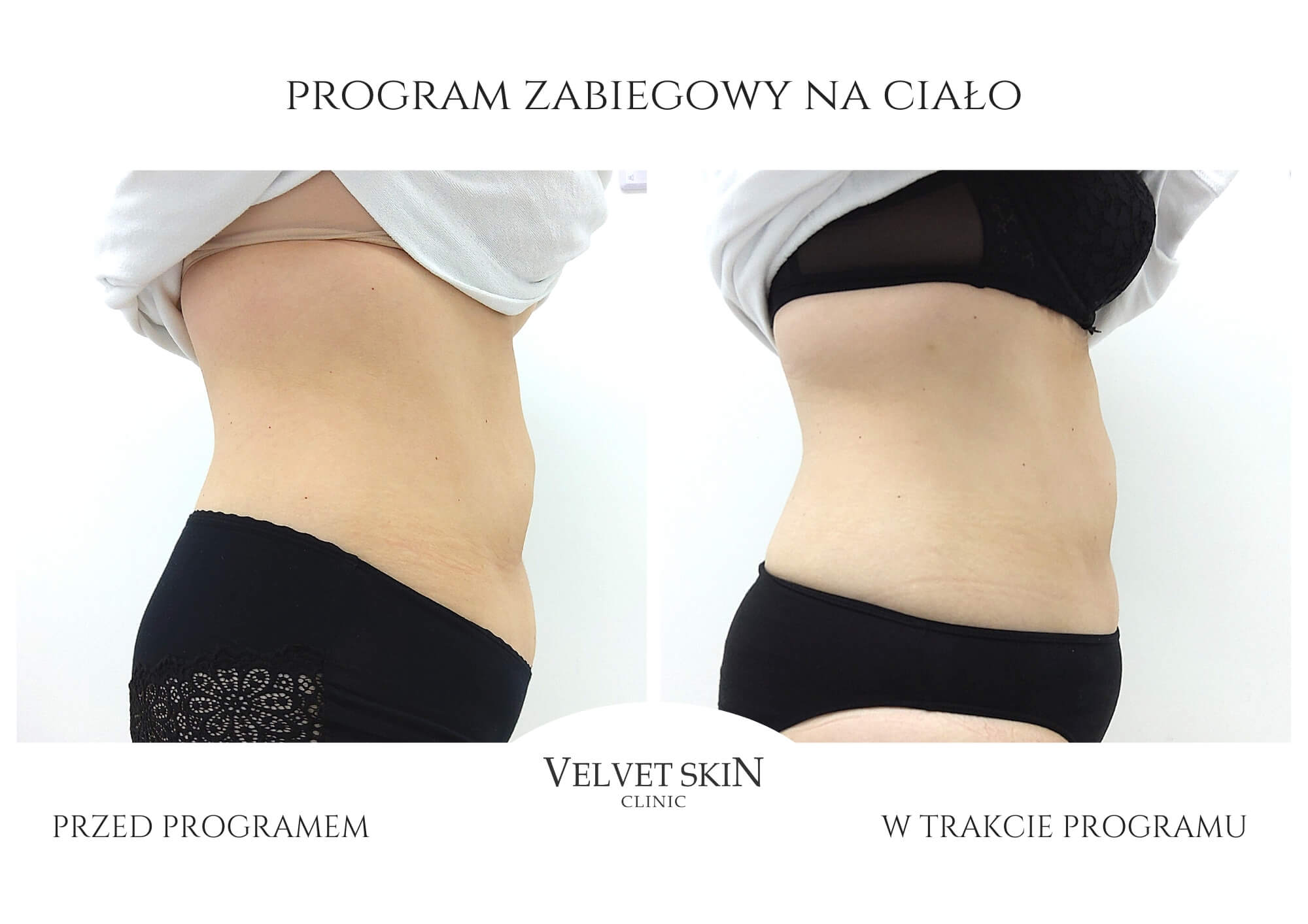 Slim Body Premium autorski program modelujący ciało — efekt zabiegów w Velvet Skin Clinic