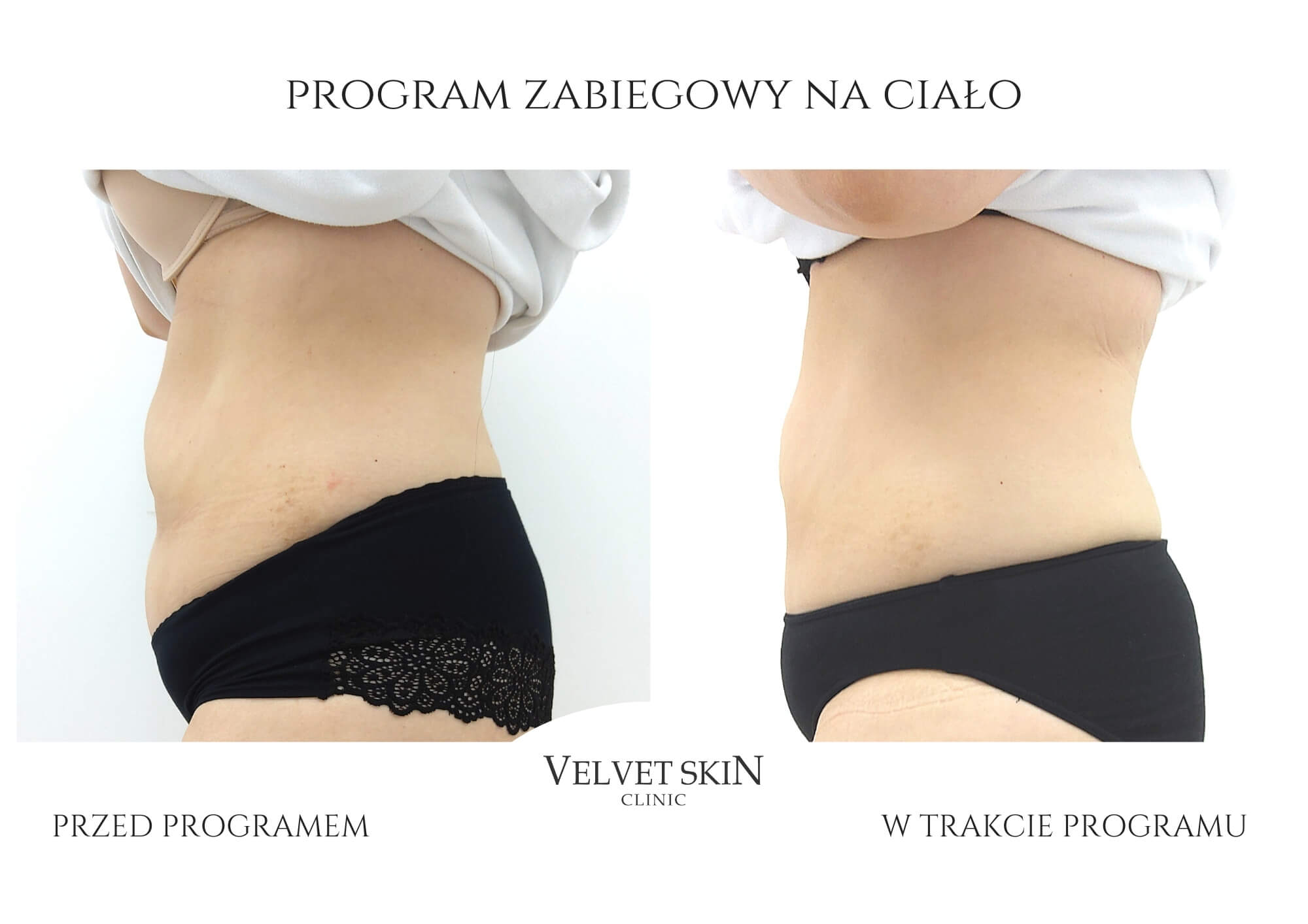Slim Body Premium autorski program modelujący ciało — efekt zabiegów w Velvet Skin Clinic