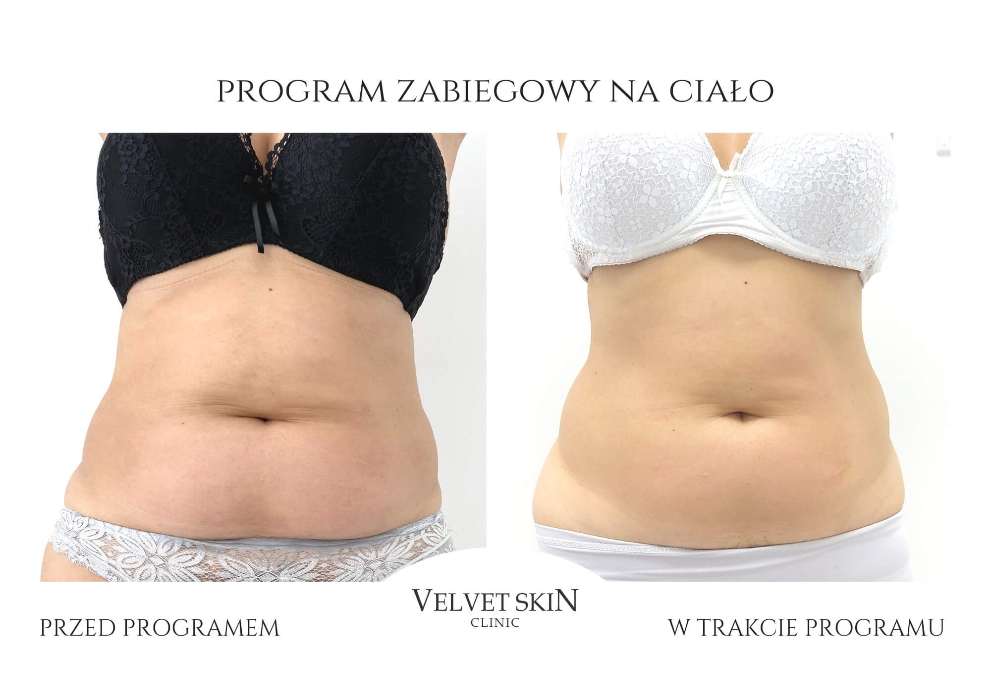 Slim Body Premium autorski program modelujący ciało — efekt zabiegów w Velvet Skin Clinic