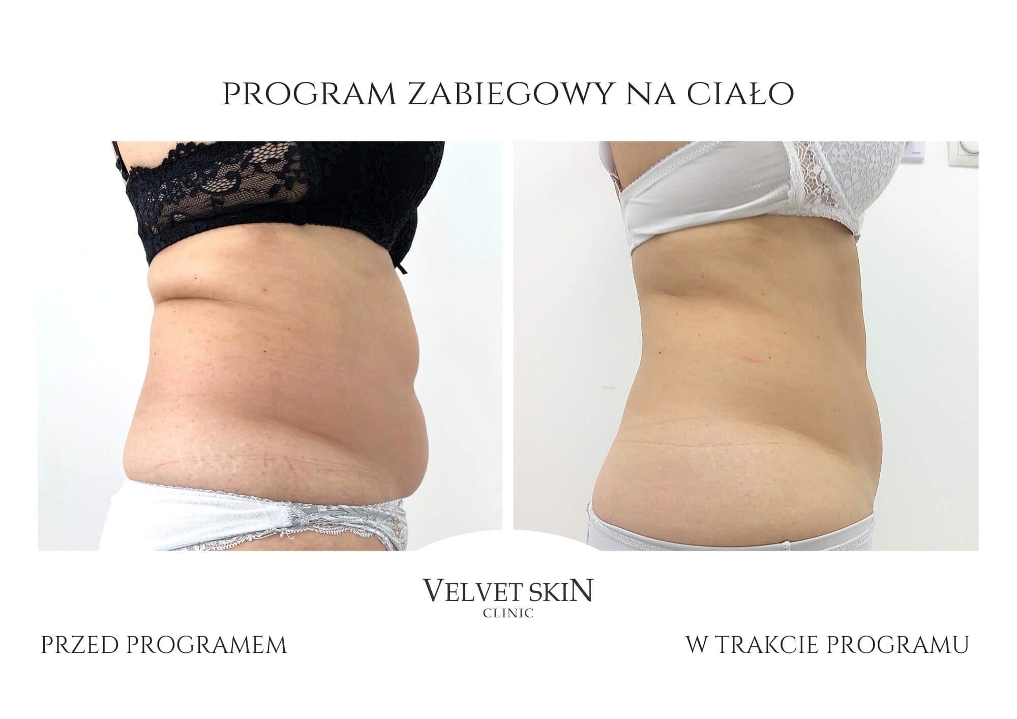 Slim Body Premium autorski program modelujący ciało — efekt zabiegów w Velvet Skin Clinic