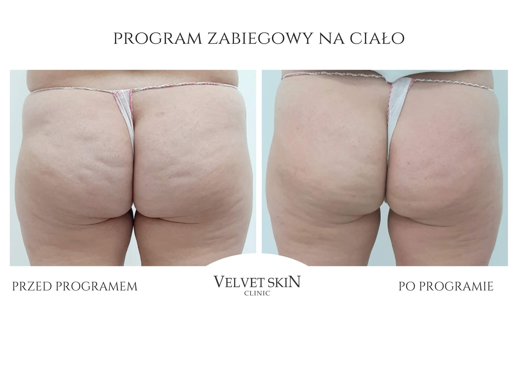 Slim Body Premium autorski program modelujący ciało — efekt zabiegów w Velvet Skin Clinic