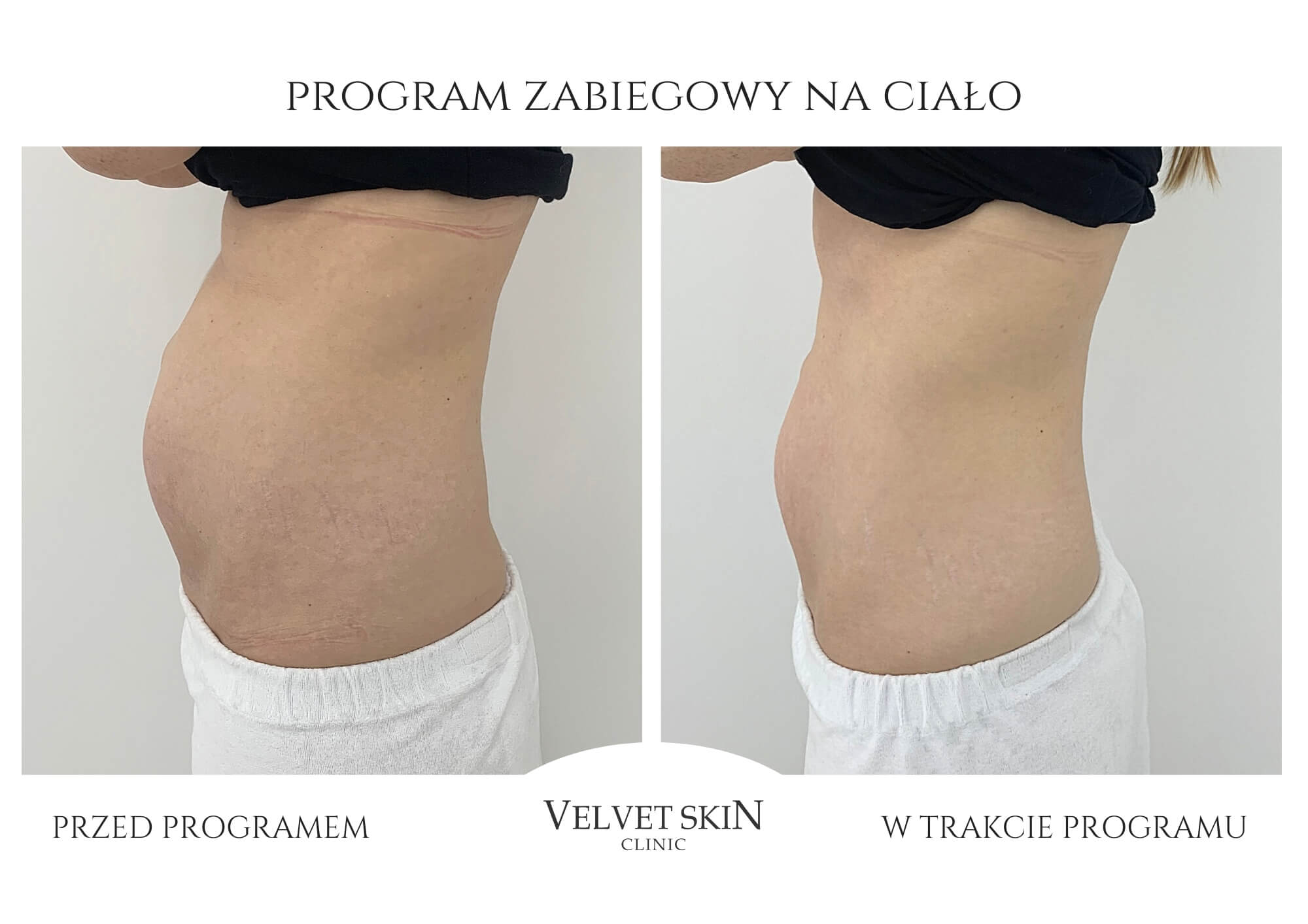 Slim Body Premium autorski program modelujący ciało — efekt zabiegów w Velvet Skin Clinic