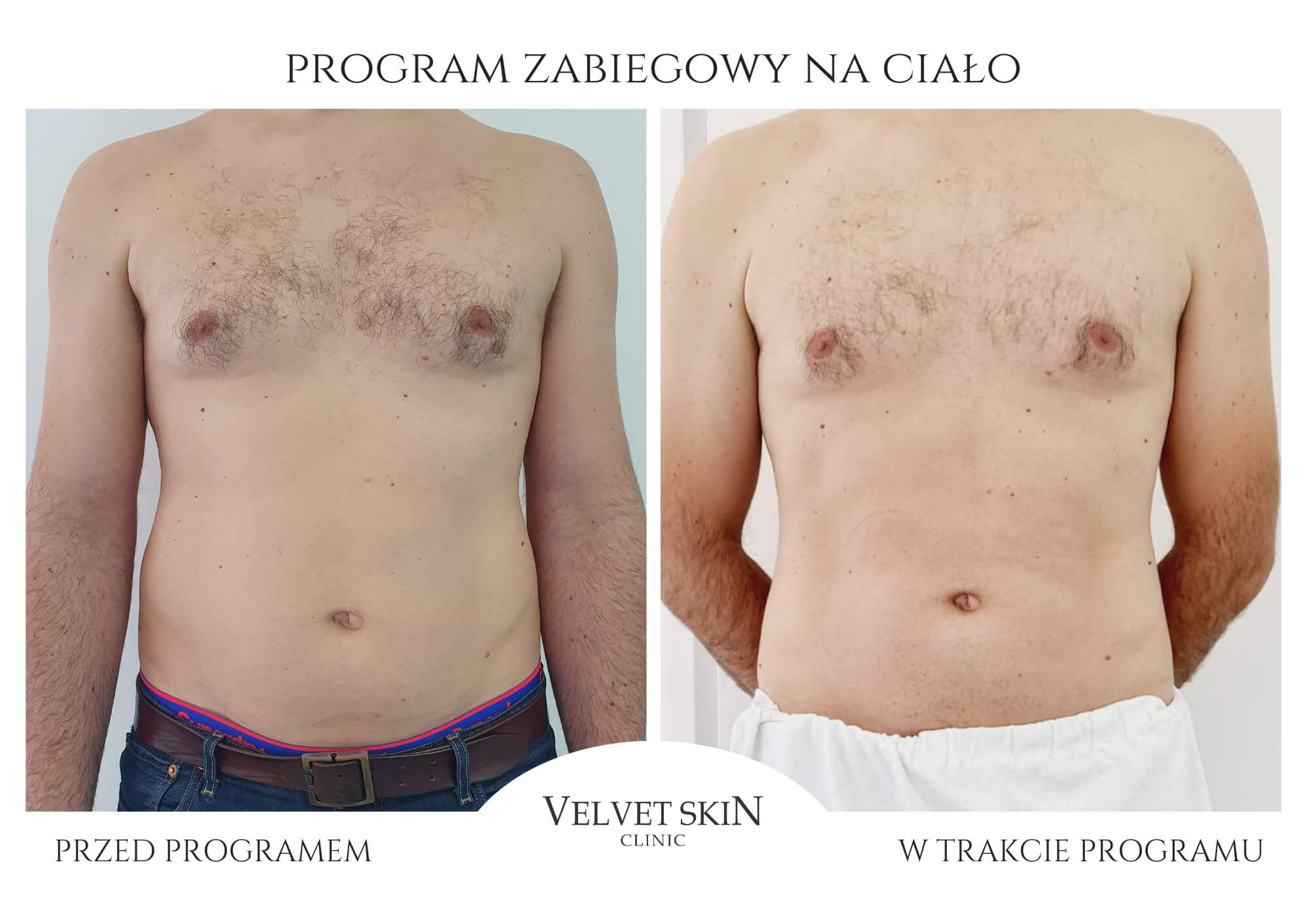 Slim Body Premium autorski program modelujący ciało — efekt zabiegów w Velvet Skin Clinic