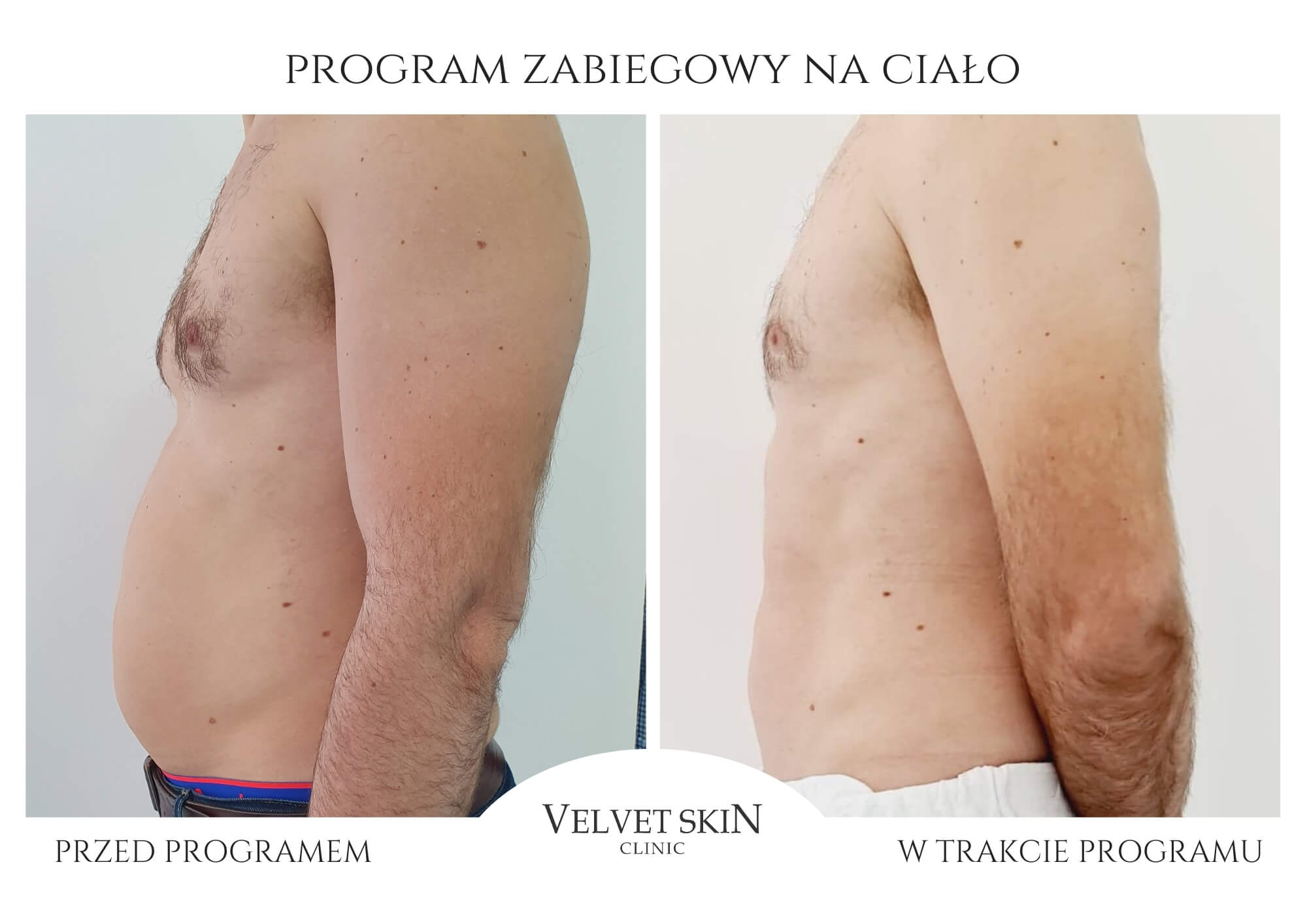 Slim Body Premium autorski program modelujący ciało — efekt zabiegów w Velvet Skin Clinic