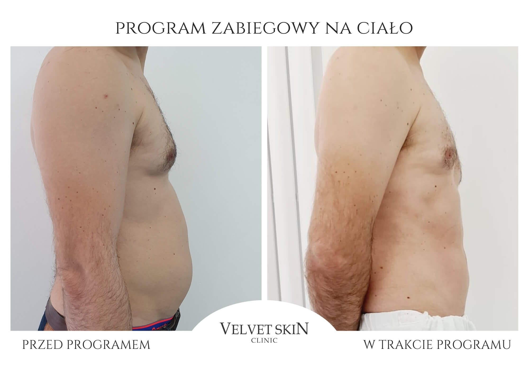 Slim Body Premium autorski program modelujący ciało — efekt zabiegów w Velvet Skin Clinic