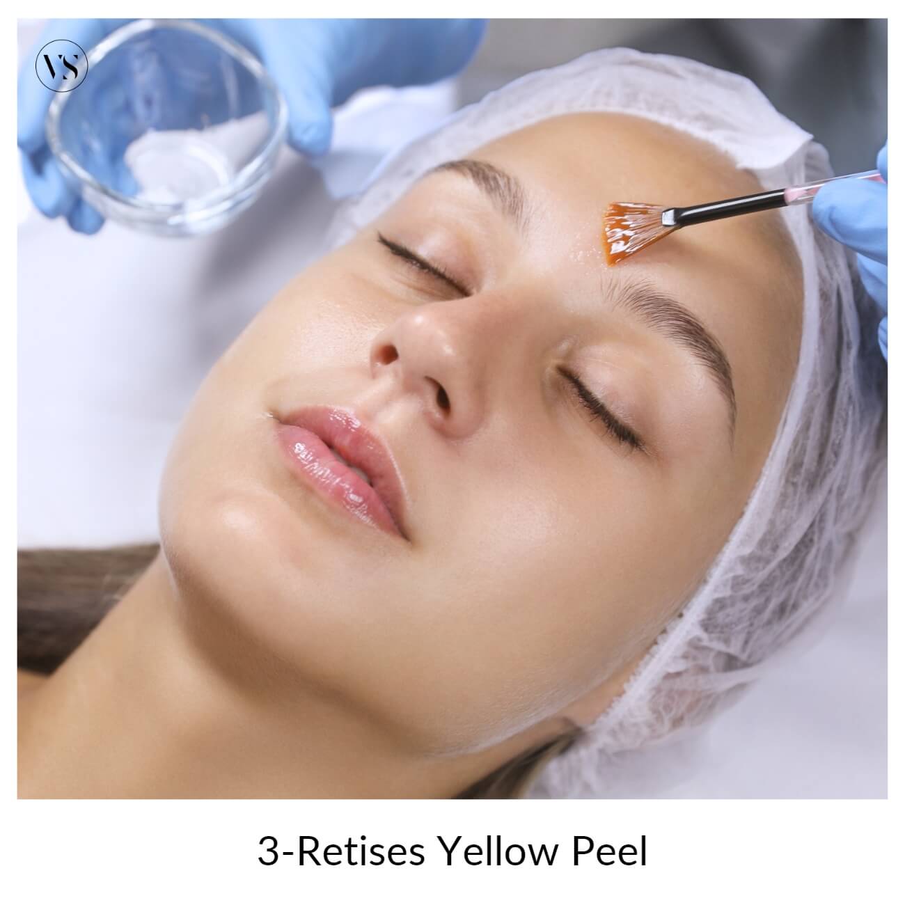3-retises yellow peel