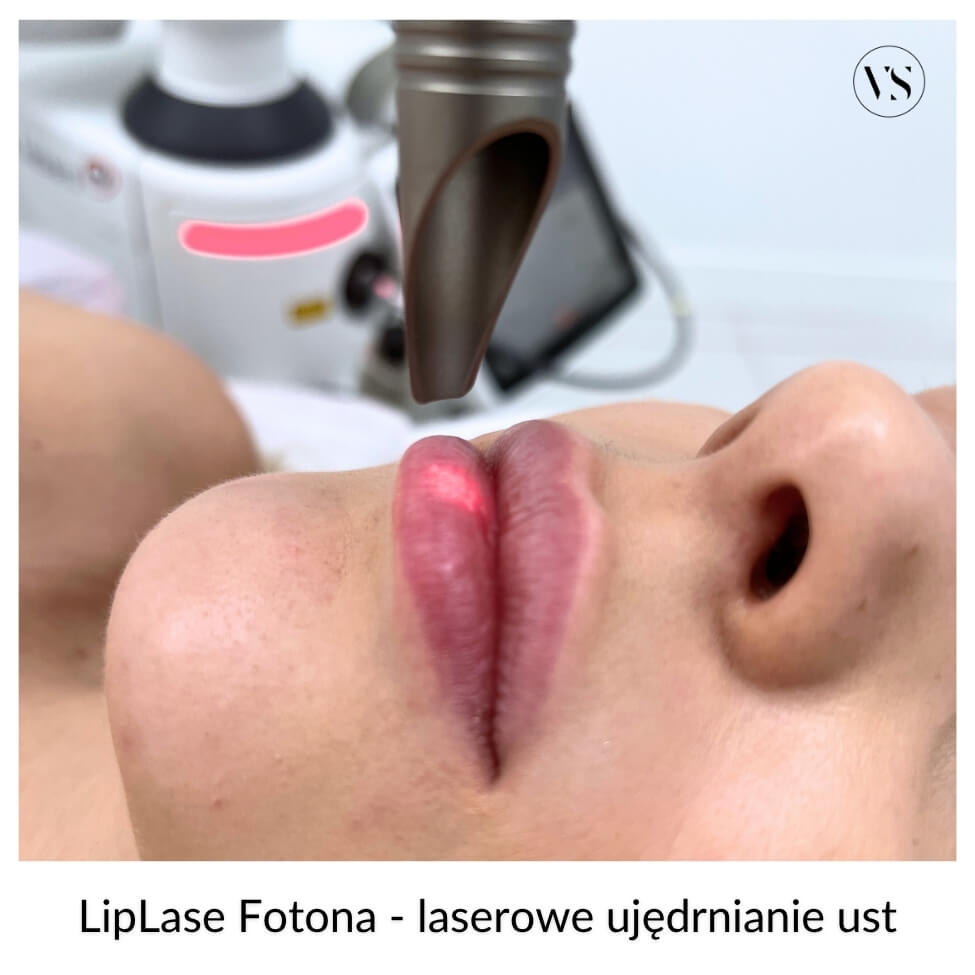 LipLase