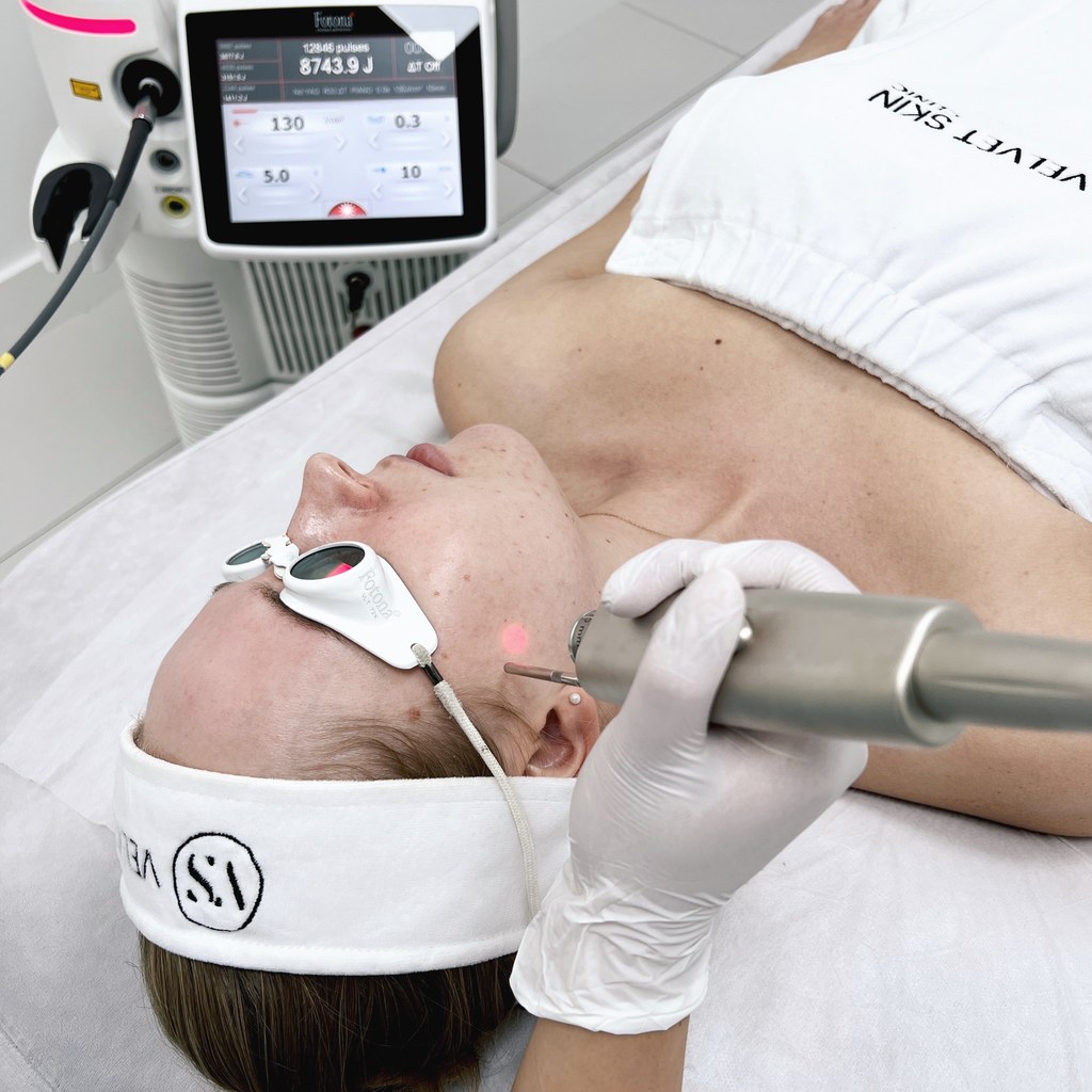 Laserowy zabieg Fotona na twarz w Velvet Skin Clinic