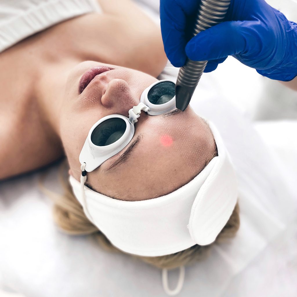 Laserowy resurfacing twarzy Fotona w Velvet Skin Clinic